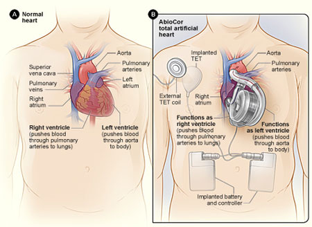 Normal heart and AbioCor total artificial heart