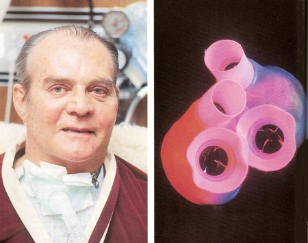 Dr. Barney Clark and the Jarvik-7 artificial heart he received
