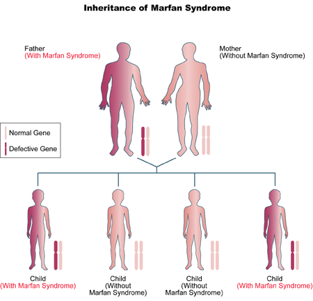 Image result for marfan syndrome
