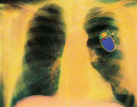 X-ray of a patient's chest, showing a fitted pacemaker