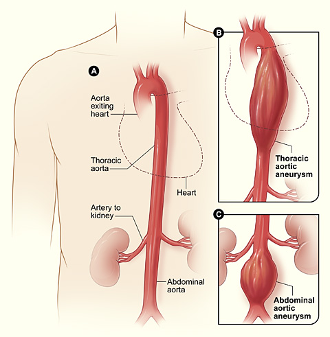 ruptured  aorta
