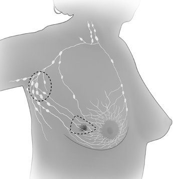 breast-sparing surgery