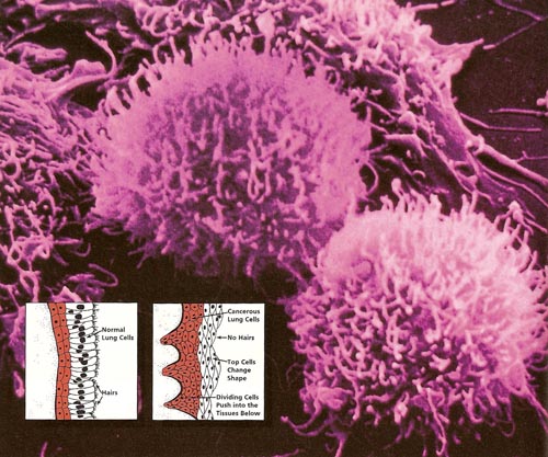 cancer cells pictures. cancer cells