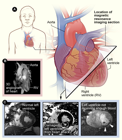 MRI imaging of the heart