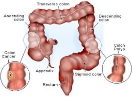 colon cancer and polyps