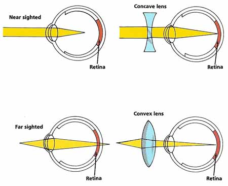 corrective lenses for eyes