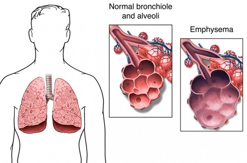 alveoli affected by emphysema