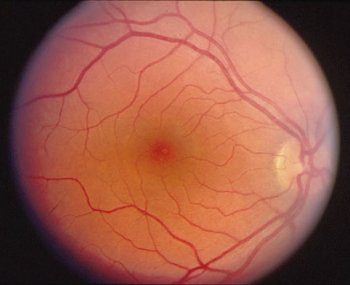 retina, showing fovea (dark) and surrounding macular region (yellow) at center