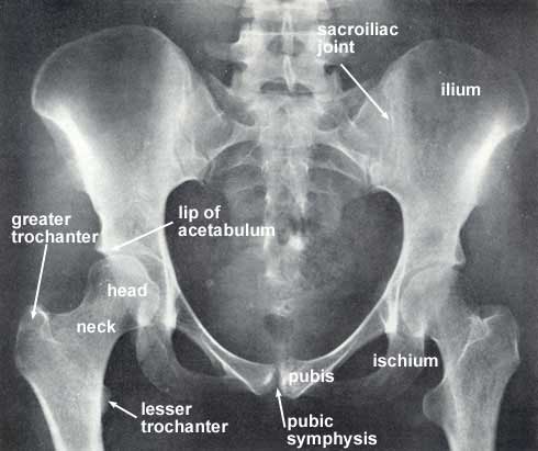 radiograph of the hip