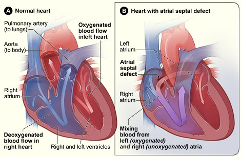 normal heart and heart with atrial septal defect (ASD)