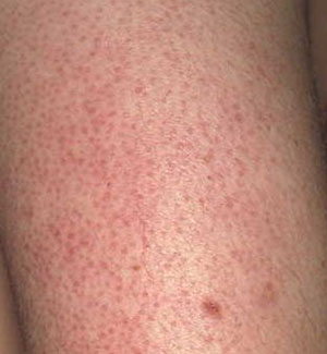 skin rash upper arms - MedHelp