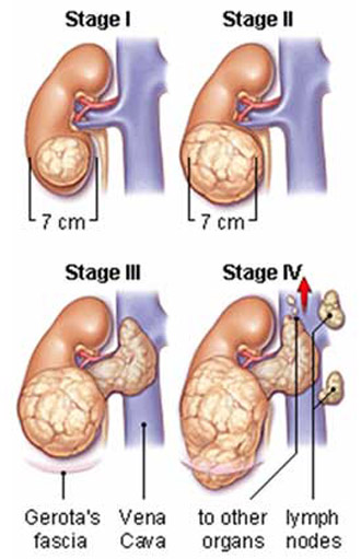 kidney cancer staging