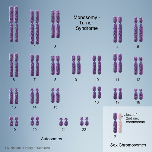monosomy in Turner's syndrome