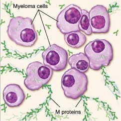 myeloma cells