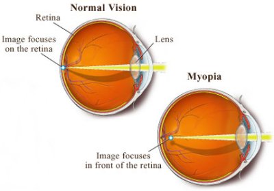 myopia explained