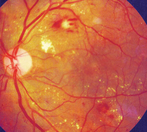 non-proliferative diabetic retinopathy