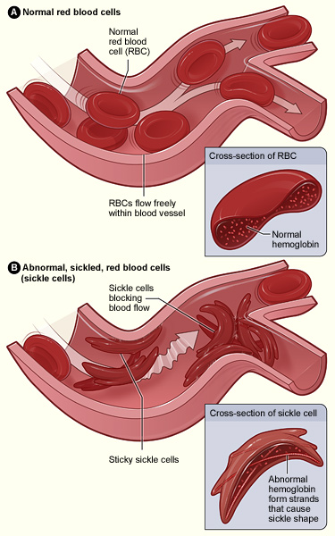 normal and sickled blood flow