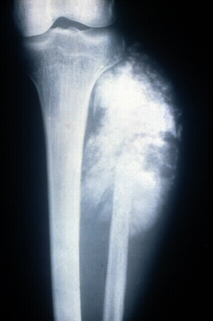 cloudy X-ray appearance of osteosarcoma