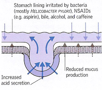 stomach lining irritation by bacteria