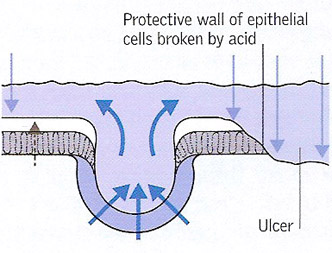 development of a peptic ulcer