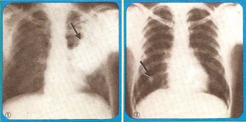 X-rays of cases of lobar and bronchopneumonia