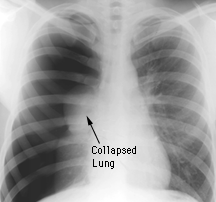 X-ray of right lung pneumothorax