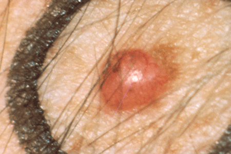 Skin Cancer Bump On Face