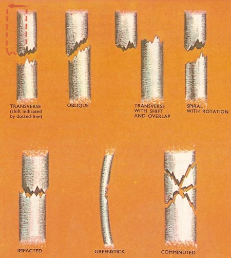 types of fracture