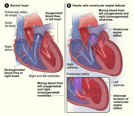Causes Of Ventricular Septal Defect In Children