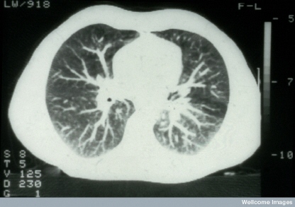 chest CT scan