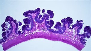 colon polyps