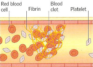 Blood clot within a blood vessel
