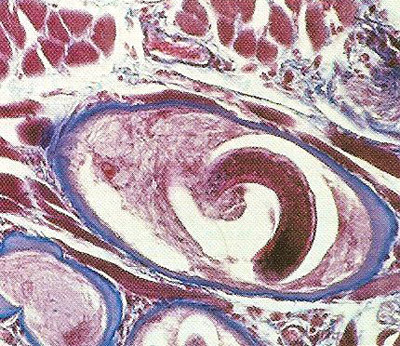 Light micrograph of tissue taken from a biosopy sample taken from a patient's muscle shows a cyst formed by a Trichinella spiralis larva, an infestation of which causes trichinosis