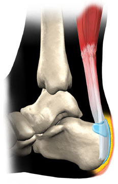 Achilles tendinitis