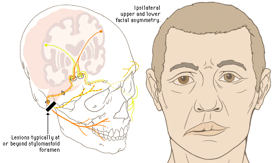 Bell's palsy