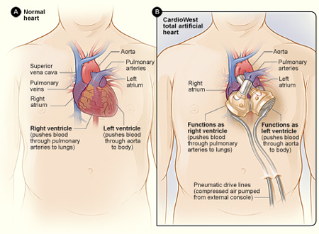 Normal heart and CardioWest total artificial heart