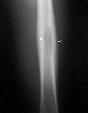 Ewing's sarcoma of the femur