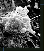 An HIV-infected cell undergoing apoptosis