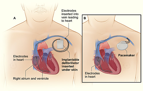 ICD and pacemaker