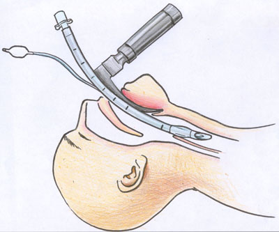 intubation