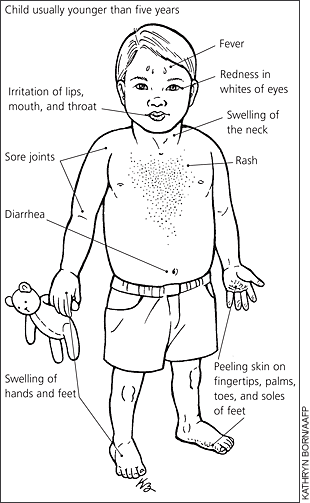 Kawasaki disease signs and symptoms