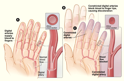 Raynaud's disease