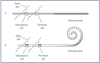 Two double-cuff Tenckhoff peritoneal catheters: standard (A), curled (B)