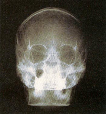 X-ray of a human skull