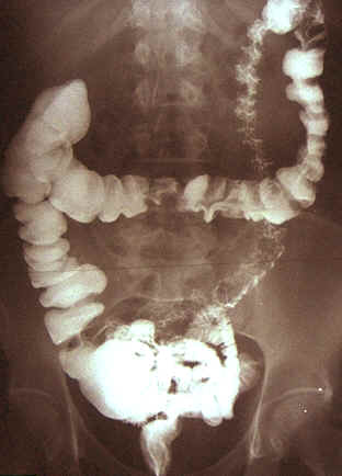 X-ray of the lower GI with barium 
            contrast
