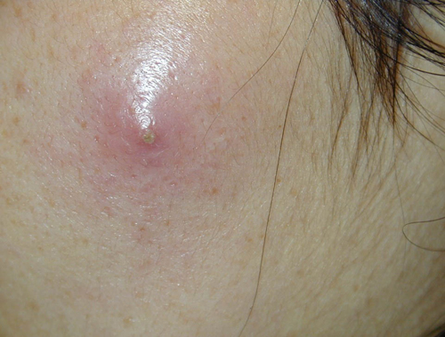 small skin abscess or boil