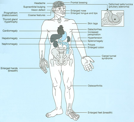 characteristics of acromegaly