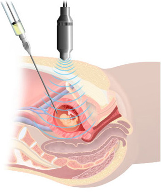 amniocentesis