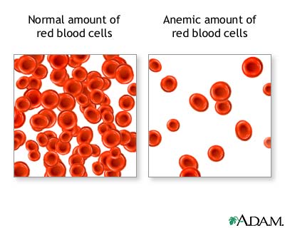 red blood cells, normal and anemic