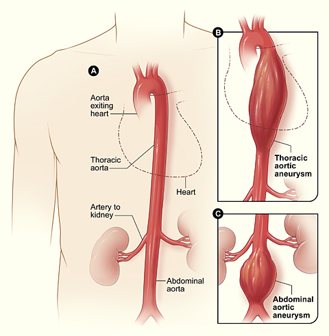 aortic aneurysm